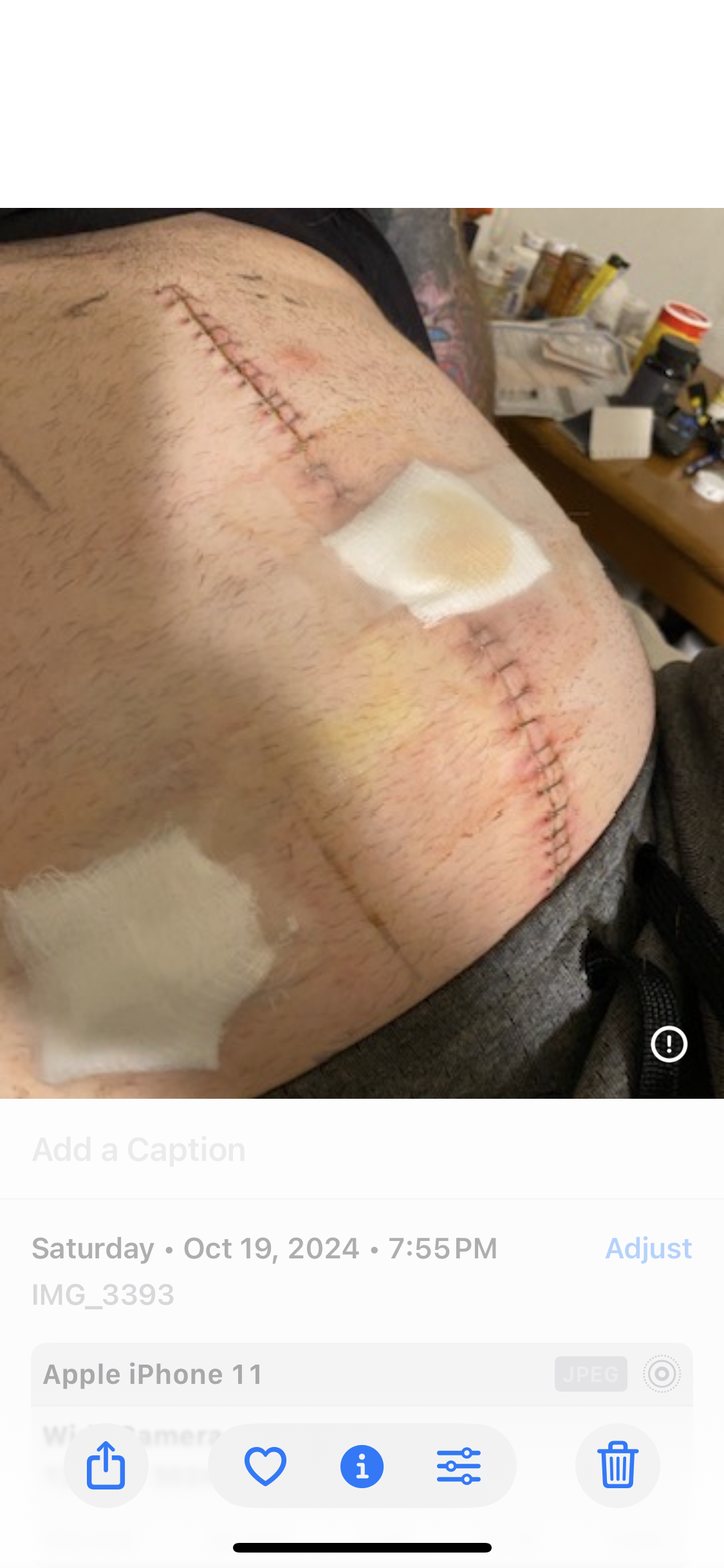 Post-surgical staples — abdomen — October 19 2024 — 8 days after collision