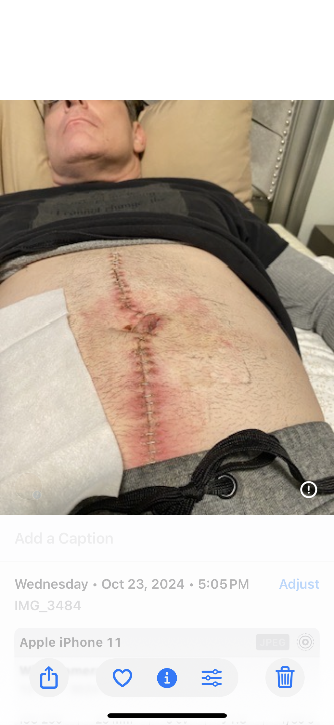 Post-surgical staples — abdomen — October 23 2024 — 12 days after collision